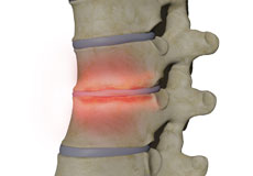 Spondylodiscitis