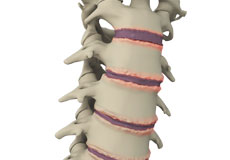 Surgical Treatment for Spine Conditions