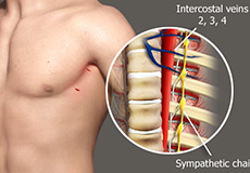 Lumbar Sympathetic Block