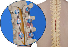 Thoracic Corpectomy