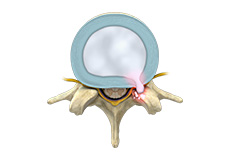 Thoracic Disc Herniation