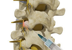 Thoracic Facet Joint Injection