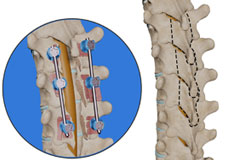 Thoracic Laminectomy