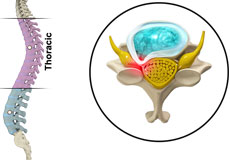 Thoracic Myelopathy