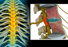 Thoracic Nerve Compression