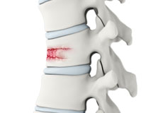 Thoracic Spine Fracture Repair Surgery