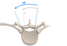 Transpedicular Approach Surgery