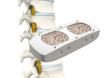 XLIF - Extreme Lateral Interbody Fusion